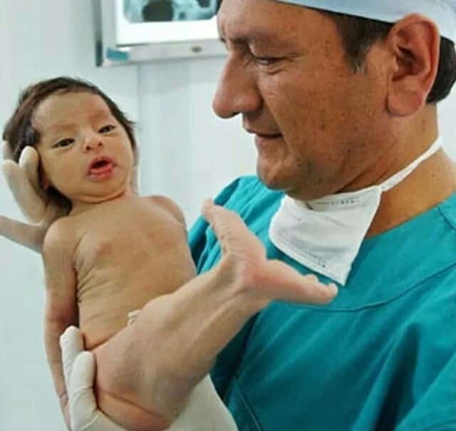 Ребенок с синдромом русалки родился в Индии. Что такое сиреномелия