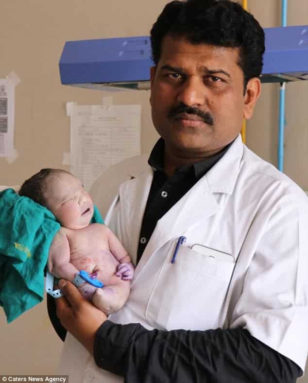 Ребенок с синдромом русалки родился в Индии. Что такое сиреномелия