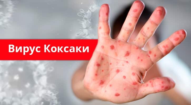 Вирус Коксаки в Турции в 2019 году: есть или нет, симптомы и профилактика